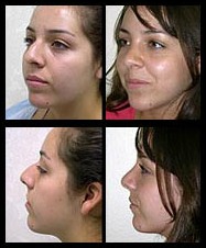 Rhinoplasty before and after pictures