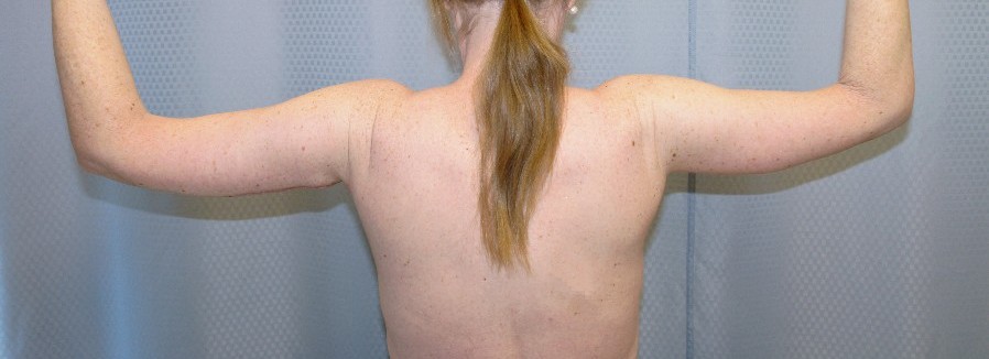 brachioplasty-arm-lift-sagging-arm-skin-claremont-upland-woman-after-back-dr-maan-kattash