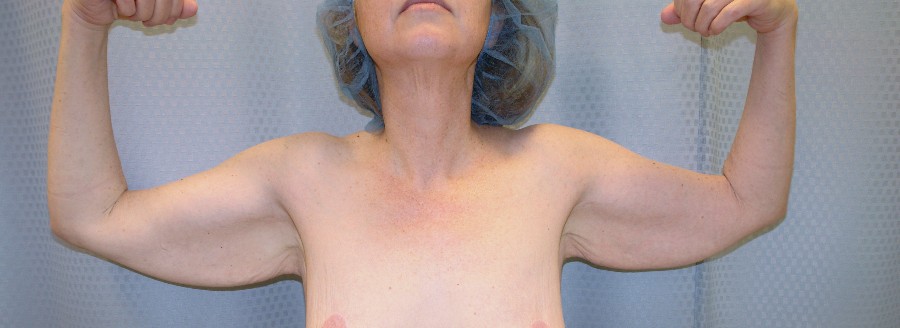 Brachioplasty Before and After Pictures