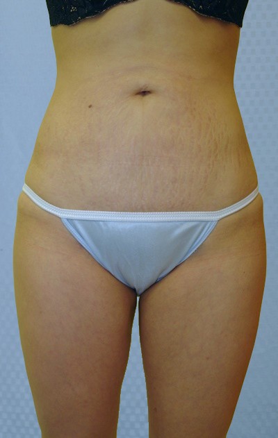 brazilian-butt-lift-augmentation-plastic-surgery-upland-victorville-woman-after-front-dr-maan-kattash