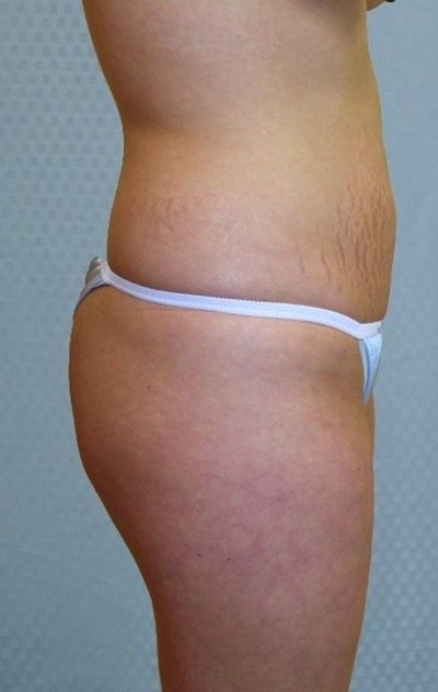 brazilian-butt-lift-augmentation-plastic-surgery-upland-victorville-woman-before-side-dr-maan-kattash