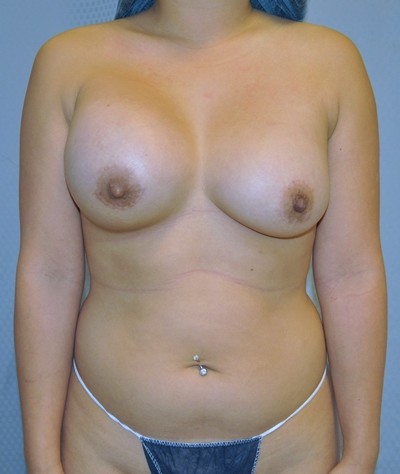 breast-revision-capsular-contracture-surgery-rancho-cucamonga-woman-before-front1-dr-maan-kattash