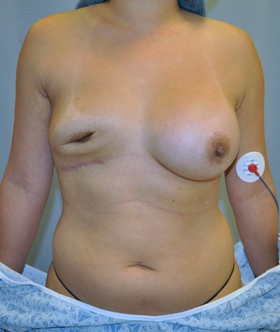 breast-revision-capsular-contracture-surgery-rancho-cucamonga-woman-before-front2-dr-maan-kattash