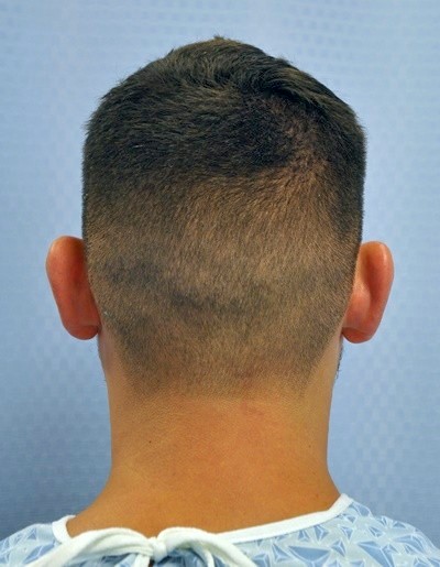 otoplasty-ear-surgery-pinning-correction-orange-county-irvine-man-before-back-dr-maan-kattash