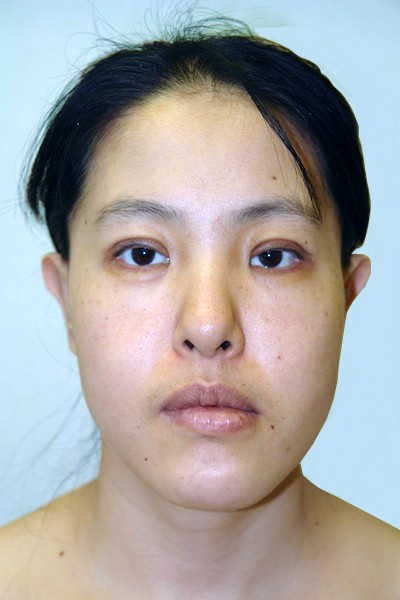 otoplasty-prominent-ear-surgery-pinning-correction-beverly-hills-woman-after-front-dr-maan-kattash