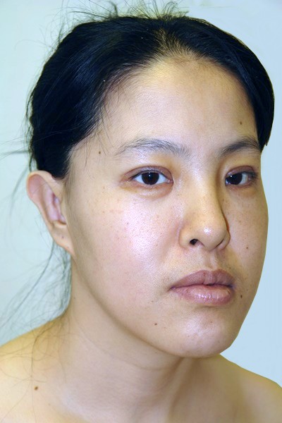 otoplasty-prominent-ear-surgery-pinning-correction-beverly-hills-woman-after-oblique-dr-maan-kattash