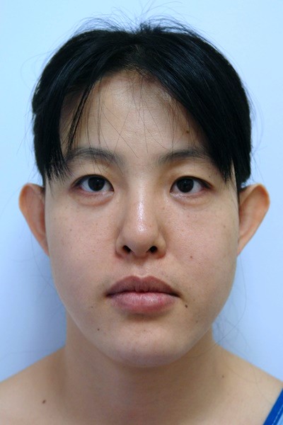 otoplasty-prominent-ear-surgery-pinning-correction-beverly-hills-woman-before-front-dr-maan-kattash