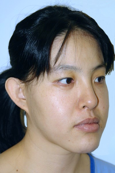 otoplasty-prominent-ear-surgery-pinning-correction-beverly-hills-woman-before-oblique-dr-maan-kattash
