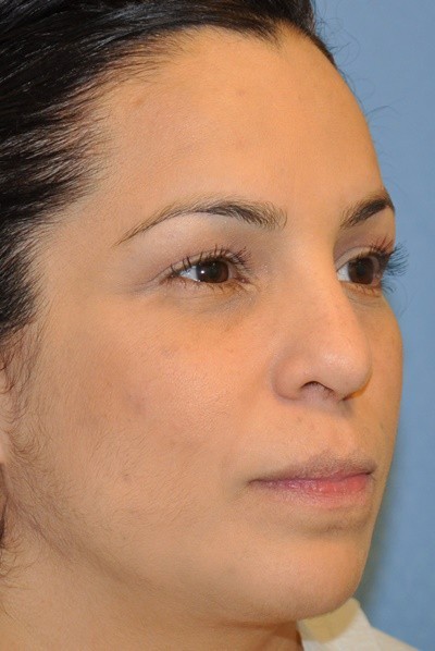 rhinoplasty-plastic-surgery-nose-job-beverly-hills-woman-after-oblique-dr-maan-kattash