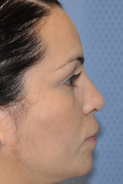 rhinoplasty-plastic-surgery-nose-job-beverly-hills-woman-after-side-dr-maan-kattash