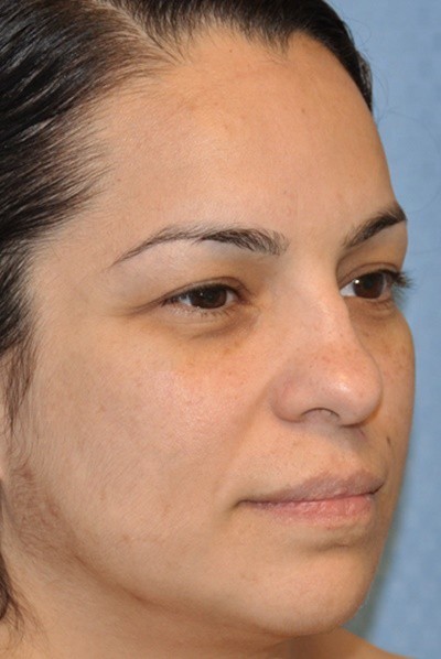 rhinoplasty-plastic-surgery-nose-job-beverly-hills-woman-before-oblique-dr-maan-kattash
