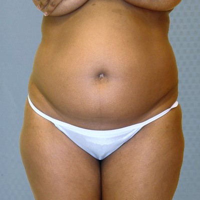 tummy-tuck-abdominoplasty-brazilian-butt-transfer-orange-county-woman-before-front-dr-maan-kattash