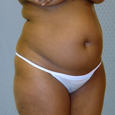 tummy-tuck-abdominoplasty-brazilian-butt-transfer-orange-county-woman-before-oblique-dr-maan-kattash