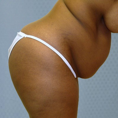 tummy-tuck-abdominoplasty-brazilian-butt-transfer-orange-county-woman-before-side-dr-maan-kattash