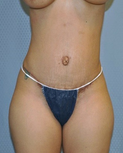tummy-tuck-abdominoplasty-hernia-repair-surgery-los-angeles-inland-empire-woman-after-front-dr-maan-kattash