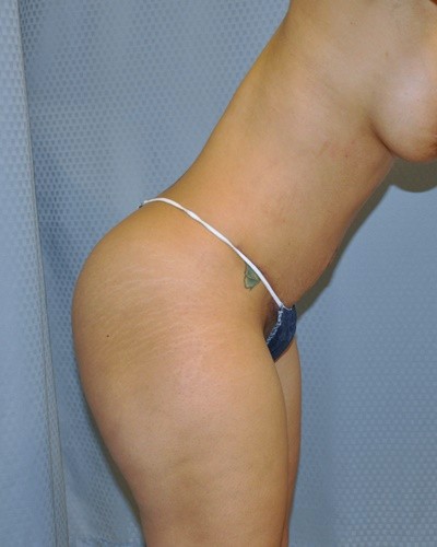 tummy-tuck-abdominoplasty-hernia-repair-surgery-los-angeles-inland-empire-woman-after-side-dr-maan-kattash