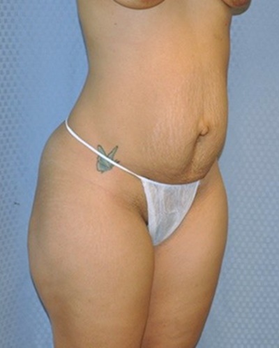 tummy-tuck-abdominoplasty-hernia-repair-surgery-los-angeles-inland-empire-woman-before-oblique-dr-maan-kattash