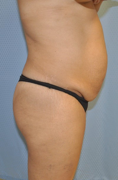 tummy-tuck-abdominoplasty-plastic-surgery-rancho-cucamonga-woman-before-side-dr-maan-kattash
