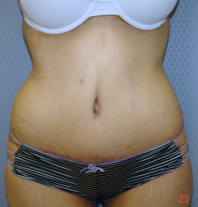tummy-tuck-abdominoplasty-surgery-rancho-cucamonga-inland-empire-woman-after-front-dr-maan-kattash