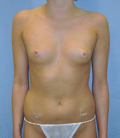 breast-enlargement-augmentation-plastic-surgery-los-angeles-woman-before-front-dr-maan-kattash