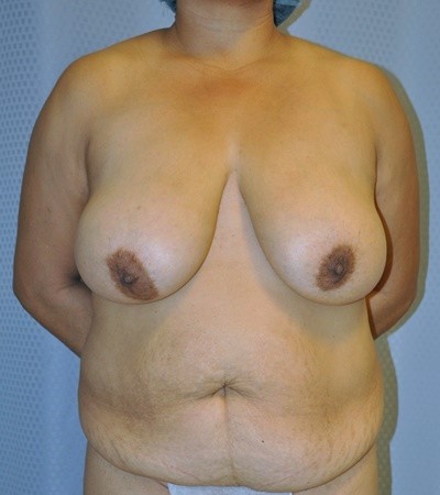 breast-reduction-plastic-surgery-rancho-cucamonga-woman-before-front-dr-maan-kattash