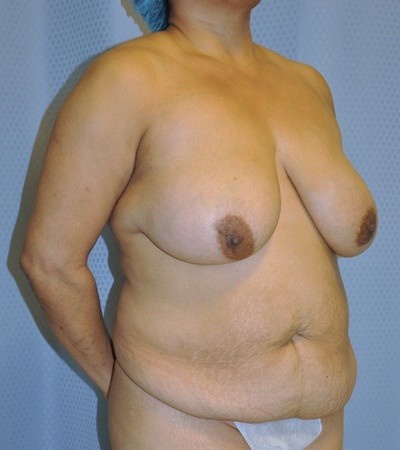breast-reduction-plastic-surgery-rancho-cucamonga-woman-before-oblique-dr-maan-kattash