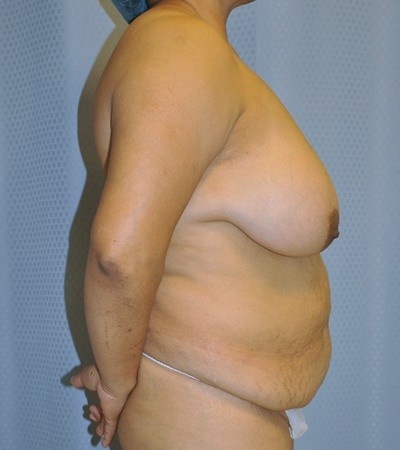 breast-reduction-plastic-surgery-rancho-cucamonga-woman-before-side-dr-maan-kattash