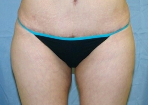 buttock-augmentation-brazilian-butt-lift-los-angeles-woman-after-front-dr-maan-kattash