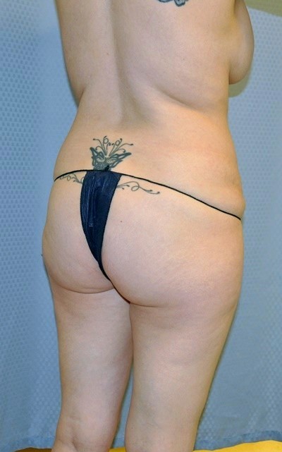 buttock-augmentation-brazilian-butt-lift-los-angeles-woman-before-oblique-dr-maan-kattash