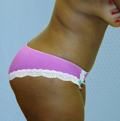 buttock-augmentation-brazilian-butt-lift-rancho-cucamonga-woman-after-bend-dr-maan-kattash