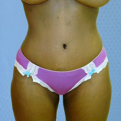 buttock-augmentation-brazilian-butt-lift-rancho-cucamonga-woman-after-front-dr-maan-kattash