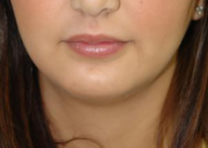 chin-augmentation-cheek-plastic-surgery-beverly-hills-woman-after-front-dr-maan-kattash2-2