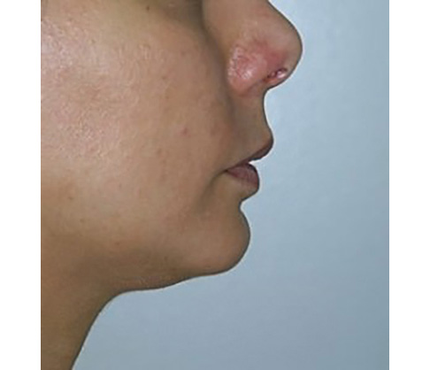 chin-augmentation-cheek-plastic-surgery-los-angeles-woman-after-side-dr-maan-kattash