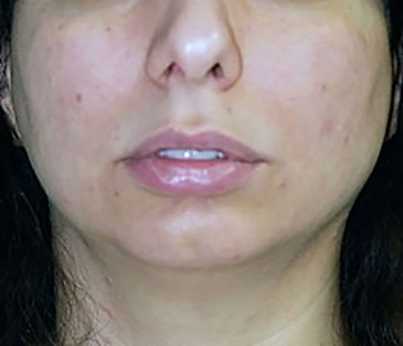 chin-augmentation-cheek-plastic-surgery-los-angeles-woman-before-front-dr-maan-kattash-2