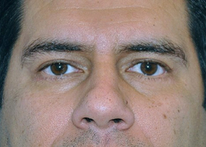 eyelid-lift-blepharoplasty-cosmetic-surgery-beverly-hills-man-after-front-dr-maan-kattash (2)