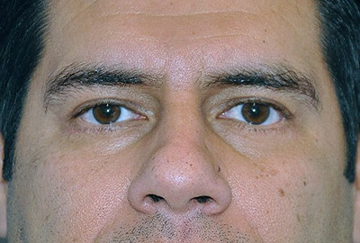 eyelid-lift-blepharoplasty-cosmetic-surgery-beverly-hills-man-after-front-dr-maan-kattash (2)