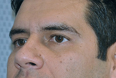 eyelid-lift-blepharoplasty-cosmetic-surgery-beverly-hills-man-after-left-oblique-dr-maan-kattash
