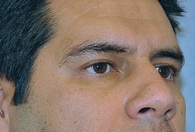 eyelid-lift-blepharoplasty-cosmetic-surgery-beverly-hills-man-after-oblique-dr-maan-kattash (2)