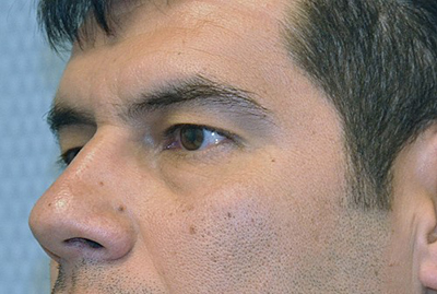 eyelid-lift-blepharoplasty-cosmetic-surgery-beverly-hills-man-before-left-oblique-dr-maan-kattash
