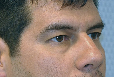 eyelid-lift-blepharoplasty-cosmetic-surgery-beverly-hills-man-before-oblique-dr-maan-kattash (2)