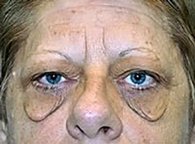 eyelid-lift-blepharoplasty-cosmetic-surgery-los-angeles-woman-before-front-dr-maan-kattash
