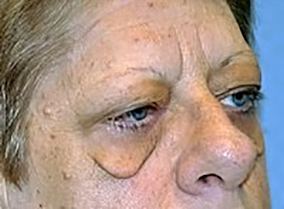 eyelid-lift-blepharoplasty-cosmetic-surgery-los-angeles-woman-before-oblique-dr-maan-kattash