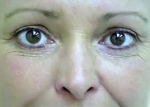 eyelid-lift-blepharoplasty-cosmetic-surgery-upland-woman-after-front-dr-maan-kattash