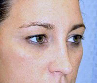 eyelid-lift-blepharoplasty-plastic-surgery-beverly-hills-woman-before-oblique-dr-maan-kattash