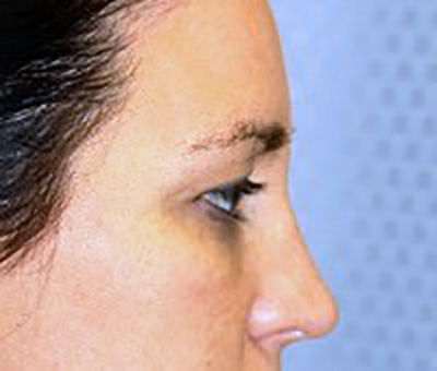 eyelid-lift-blepharoplasty-plastic-surgery-beverly-hills-woman-before-side-dr-maan-kattash