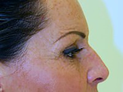 eyelid-lift-blepharoplasty-plastic-surgery-redlands-woman-after-side-dr-maan-kattash