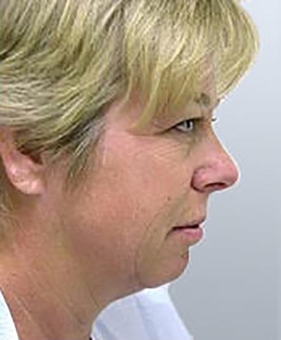 facelift-cosmetic-surgery-beverly-hills-woman-before-side-dr-maan-kattash