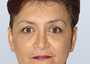 facelift-cosmetic-surgery-claremont-upland-woman-after-front-dr-maan-kattash