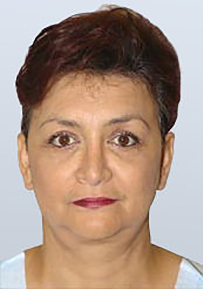 facelift-cosmetic-surgery-claremont-upland-woman-after-front-dr-maan-kattash