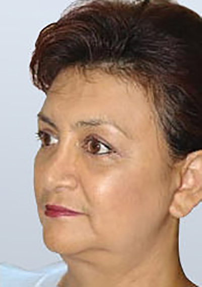 facelift-cosmetic-surgery-claremont-upland-woman-after-oblique-dr-maan-kattash